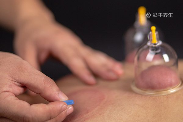拔罐多久一次合适 拔罐的注意事项有哪些
