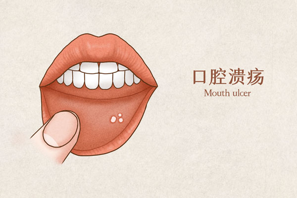 儿童口腔溃疡怎么办 口腔溃疡不能吃什么