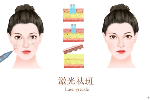 脸上有雀斑能去掉吗 脸上有雀斑是怎么引起的