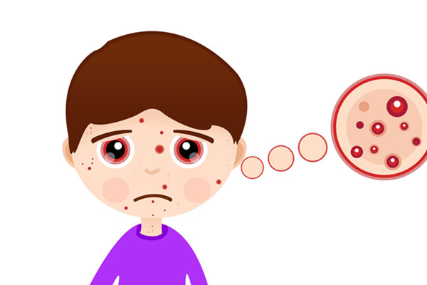 眉毛上长痘痘是什么原因 眉毛长痘痘怎么办