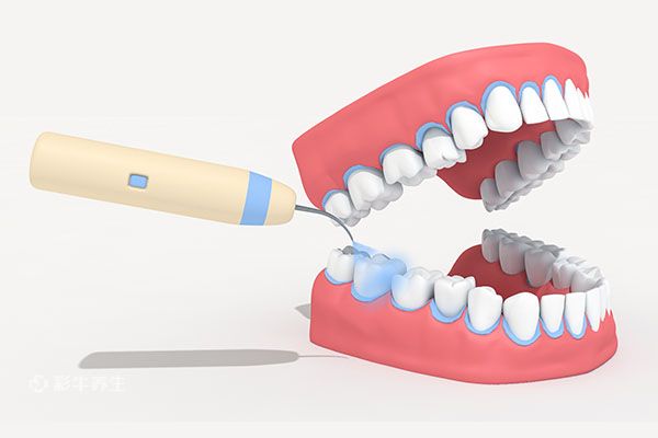 孕妇能不能洗牙 洗牙后注意事项