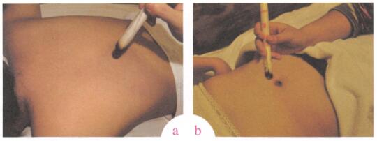 消除眼袋艾灸哪个部位图解