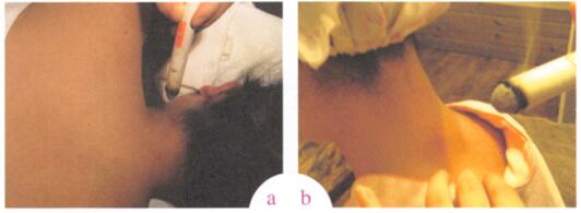 风寒感冒艾灸哪个部位图解