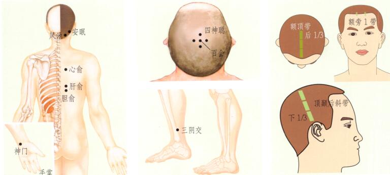 失眠刮痧部位图解