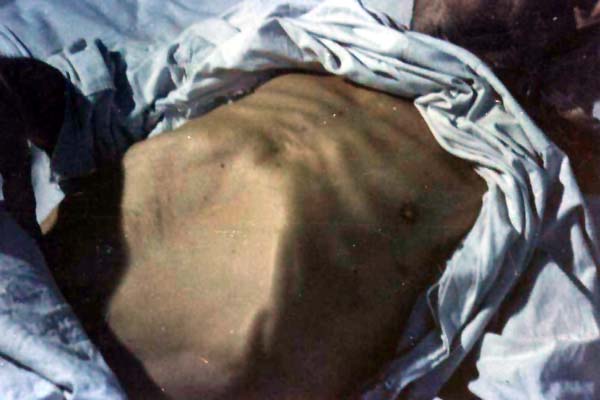 中医望肢体之桶状胸舟状腹