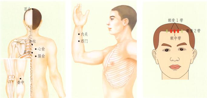 疖病-痈肿刮痧部位图解