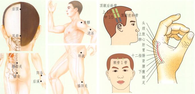 扭伤刮痧部位图解