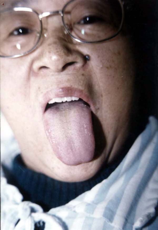 中医望鼻之鼻柱黑斑