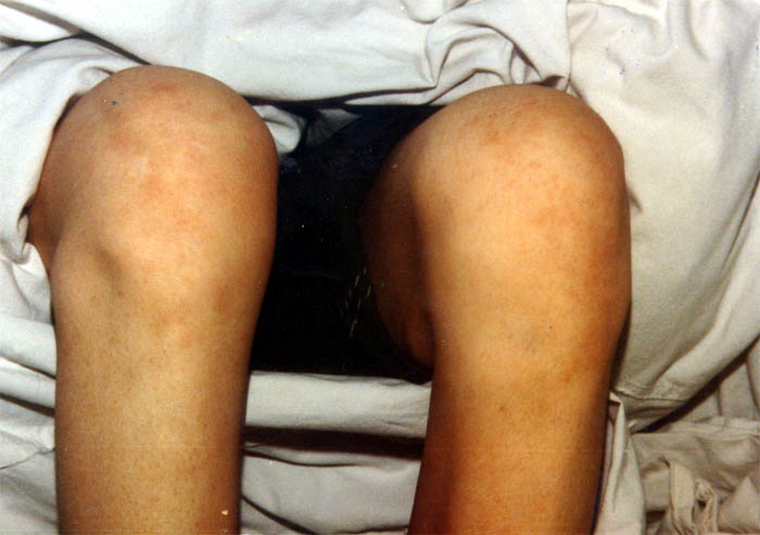 中医望肢体之膝部肿大