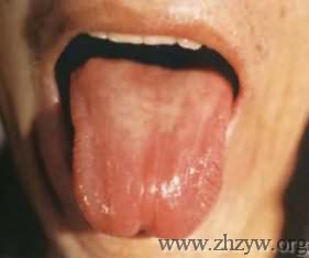 几种异常舌苔预示疾病