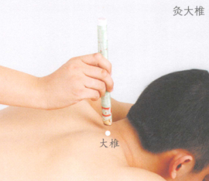 慢性支气管炎艾灸哪个部位图解