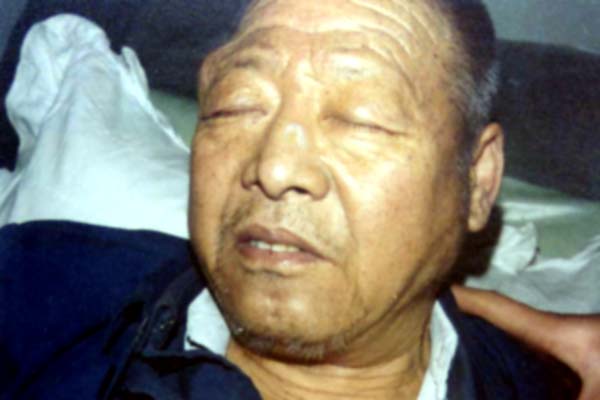 中医望色之面黄色散而沉