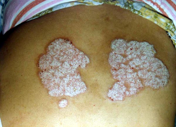 中医望皮肤之牛皮癣