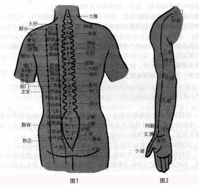 哮喘磁圆梅针疗法