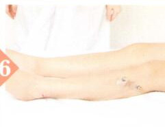 健脾养胃拔罐部位图解