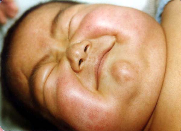 中医望色之面肿