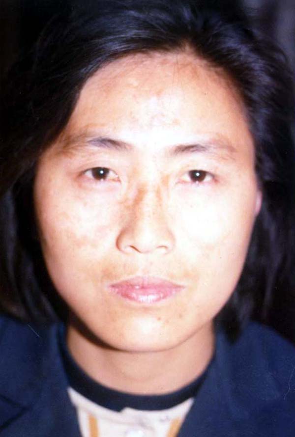 中医望色之面蝴蝶斑