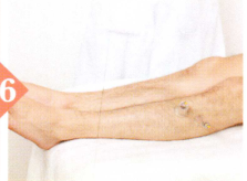 高血脂拔罐部位图解