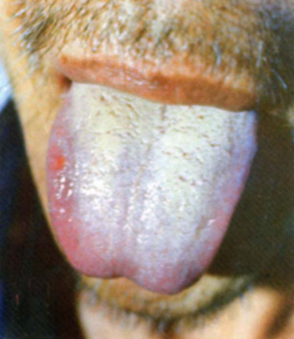 舌疔3