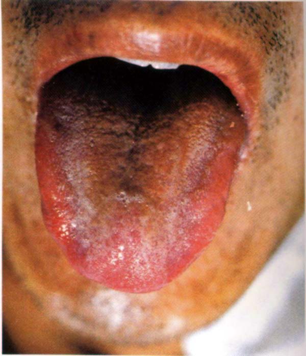 绛舌霉酱滑润苔