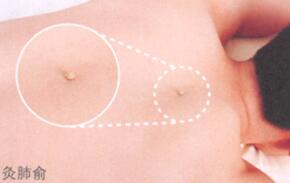 糖尿病艾灸哪个部位图解