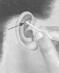 肥胖症按摩部位图解