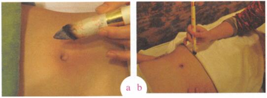 小儿疝气艾灸哪个部位图解