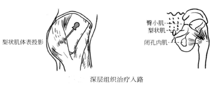 小针刀操作手术入路