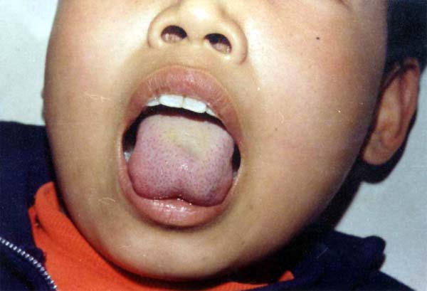 中医望口与唇之下颏、口角青黑，舌上红点