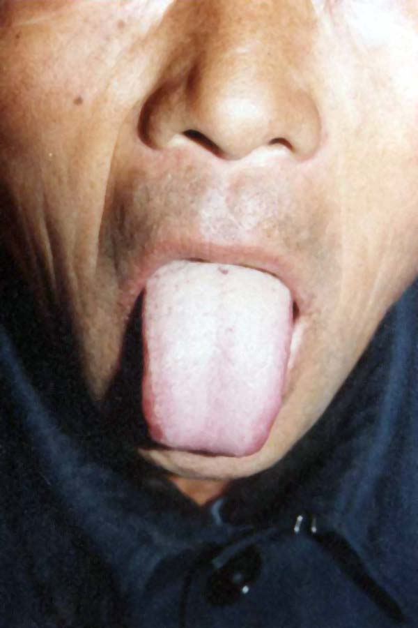 中医望鼻之鼻黄