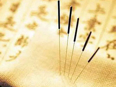 针灸：中医药走出去的“排头兵”