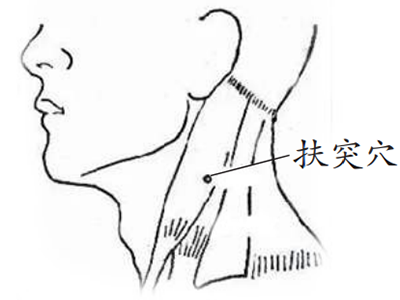 以哑门、扶突、环跳穴为主穴，针刺治疗中风后遗症