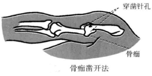 小针刀的运刀方法