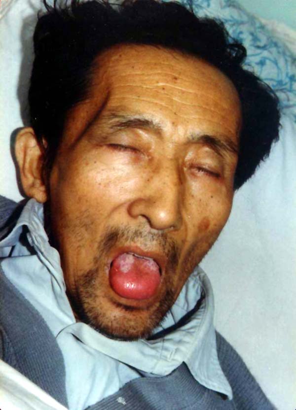 中医望色之恶色(面色黧黑,舌红肿胀)