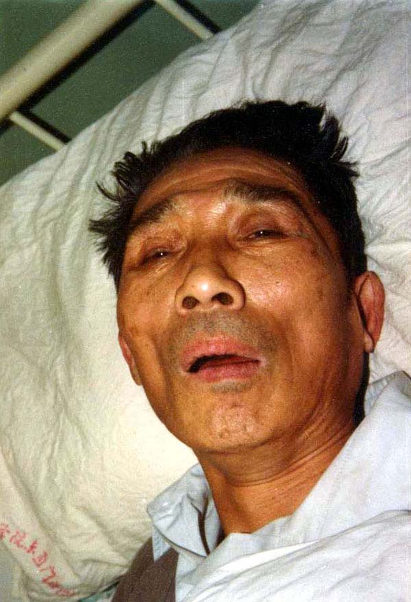 中医望神之无神(昏迷)1