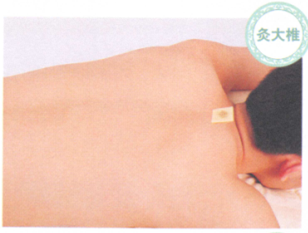 慢性支气管炎艾灸哪个部位图解