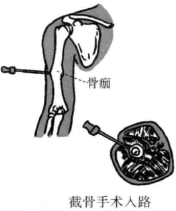 小针刀操作手术入路