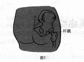 梨状肌综合征磁圆梅针疗法