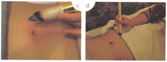 防治青春痘艾灸哪个部位图解