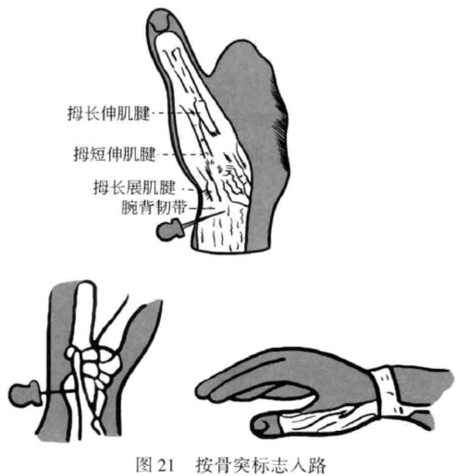 小针刀操作手术入路