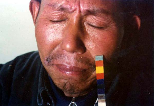 中医望色之客色赤