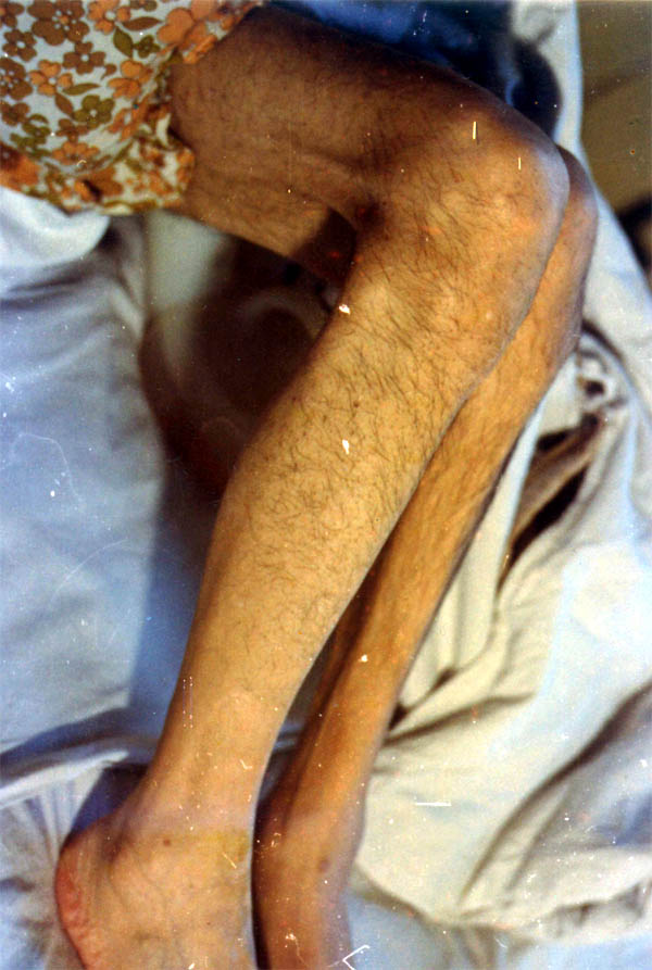 中医望形体之腿部肌肉萎缩