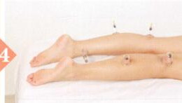 小腿抽筋拔罐部位图解