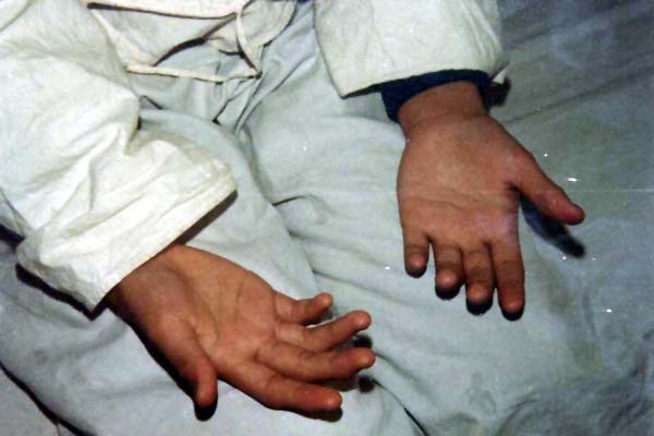 中医望肢体之杆状指