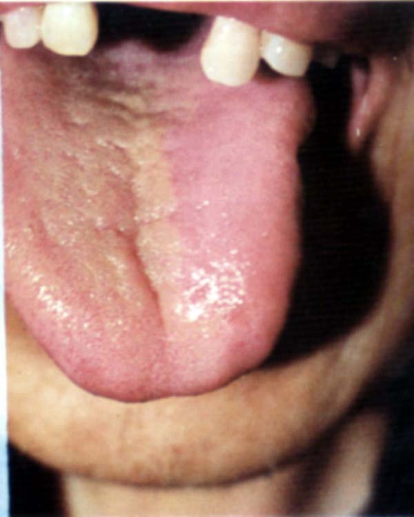 淡红舌偏黄腻苔