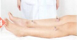 湿疹拔罐部位图解