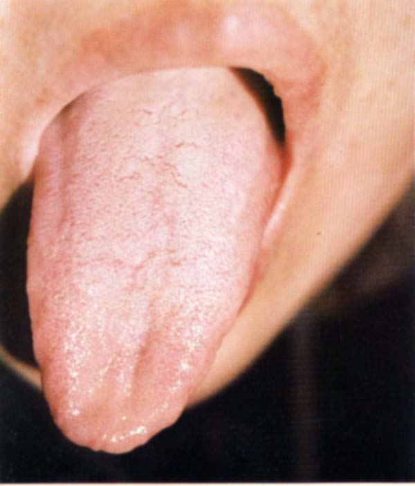 淡红瘦薄舌白糙苔