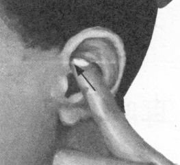 耳鸣-耳痛按摩部位图解