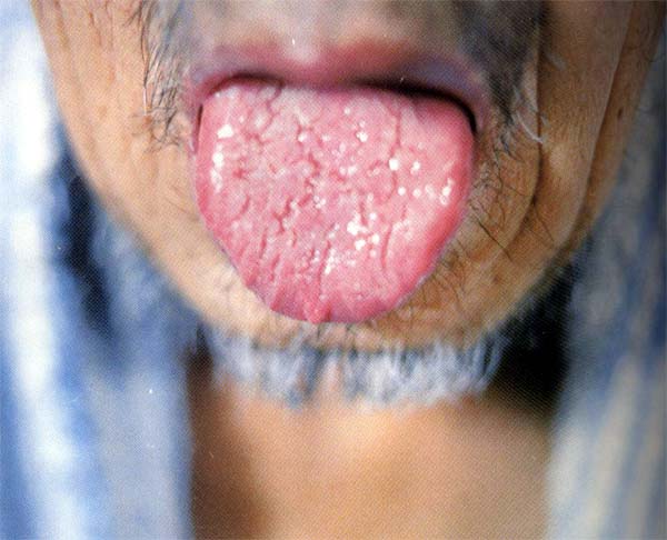 淡紫裂纹舌透明苔