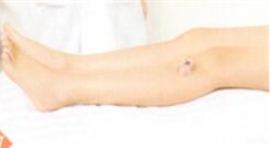 强直性脊柱炎拔罐部位图解